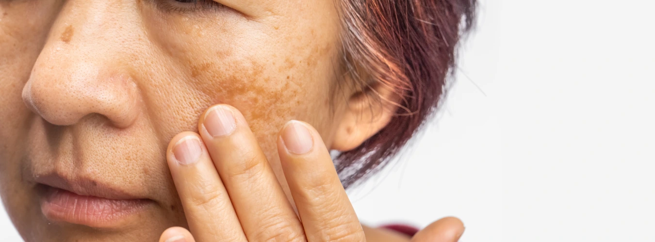 MD Dermatologist performing Fotona StarWalker laser pigmentation and melasma treatment on a patient at Cosmo Radiance clinic in Miyapur, Hyderabad